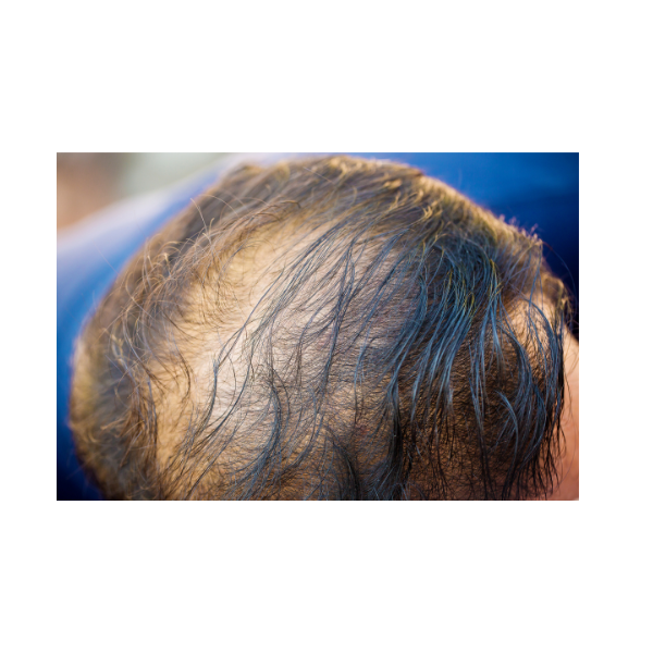 Hair Fibres: The Answer to Thinning Hair?